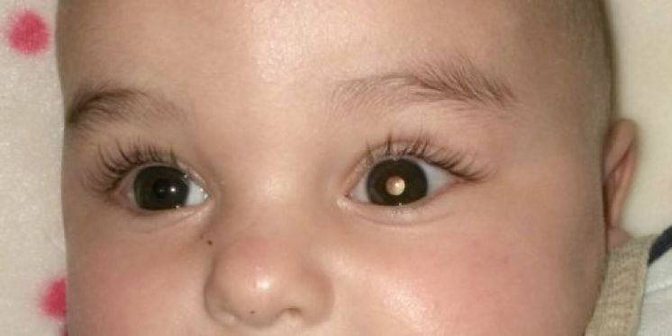 Un equip d&#039;investigadors, entre ells el Dr. Jaume Català, tracta per primera vegada en el món un retinoblastoma pediàtric amb un virus oncolític.