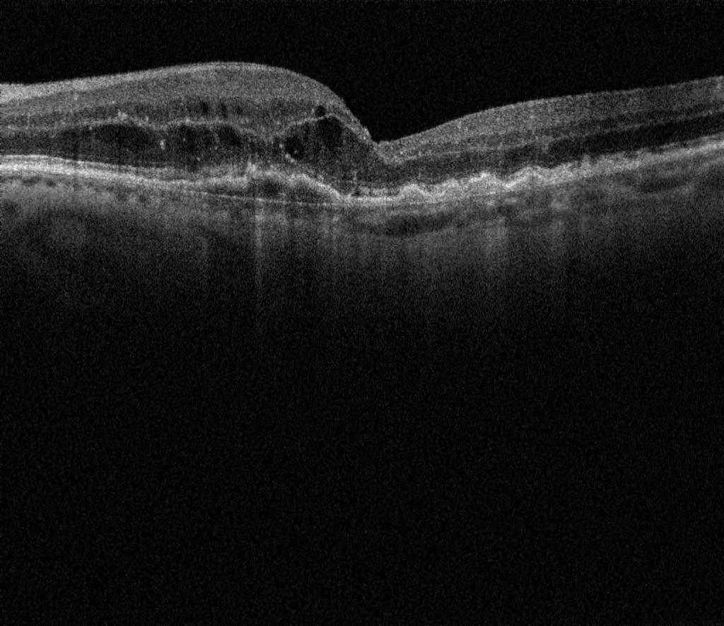 OCT degeneració macular abans del tractament antiVEGF