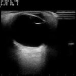 eye ultrasound